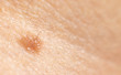 Mole mole on the skin of a person, dermatology, background, copy space. Macro