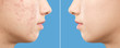 Teenage girl before and after acne treatment on blue background, closeup
