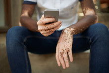 Young man with vitiligo using smartphone