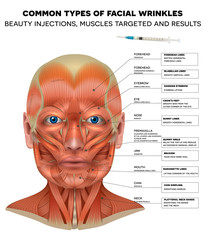 Facial injections info poster, male model face muscles anatomy. Common types of facial wrinkles. Neurotoxin injections treatment areas, treated muscles and results.