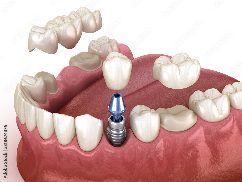 Tooth recovery with implant and crown. Medically accurate 3D illustration dental concept. - obrazy, fototapety, plakaty 
