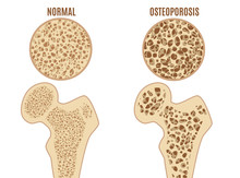 Cartoon Color Osteoporosis Bones Ad Poster Card. Vector