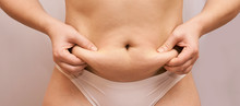 Fat Unhealthy Woman Body. Pinch Belly Side. Measurement Lady Procedure. Medicine Pinching. Anti Cellulite Overweight