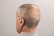 man's head with hair transplant surgery area