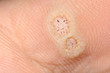 Plantar warts caused by the human papillomavirus, or HPV, on an infected foot