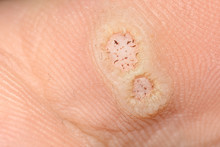 Plantar Warts Caused By The Human Papillomavirus, Or HPV, On An Infected Foot