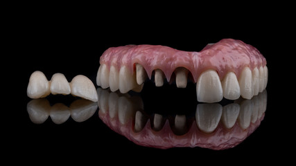 dental implants on a black background