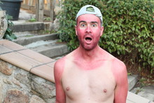  Sunburned Young Man With Extreme Tan Lines 