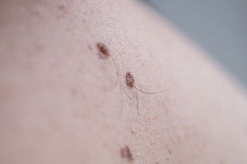 Wall Mural - Checking benign moles. Close up detail of the bare skin on a man back with scattered moles and freckles.