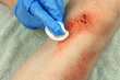 A surgical wipe being used to clean a skin abrasion