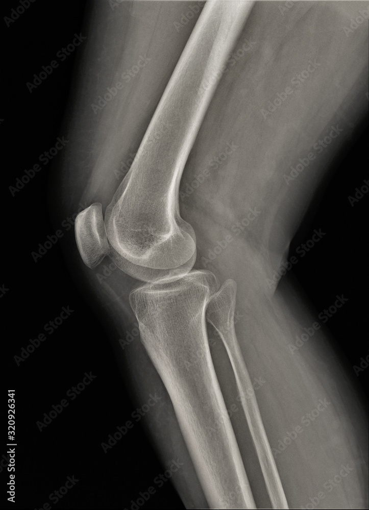 normal radiography of the knee joint in the lateral projection, medical ...