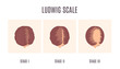 Female-pattern hair loss by Ludwig scale. 3 stages of baldness in women. Classification of alopecia shown on a head in top view. Beauty and health care concept. Medical vector illustration.