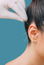 Hand Of A Reflexologist With An Acupuncture Needle Near A Woman's Ear. Treatment Of Many Diseases By Ear Acupuncture. Needles Close-up On A Blue Background