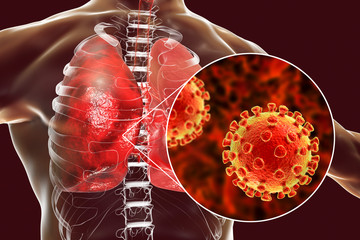 Pneumonia caused by a novel Chinese Wuhan coronavirus 2019-nCoV, conceptual 3D illustration