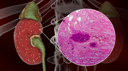 Poster - Acute pyelonephritis, gross morphology and histopathology