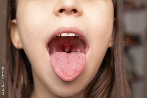 Cuadros en Lienzo angina, throat, cavity, doctor, child, infection virus, medicine, angina tonsill