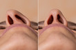 © Alessandro Grandini - Before and after a rhinoplasty to correct the deviated nasal septum