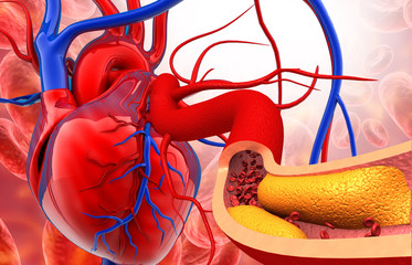 Cholesterol plaque in artery with human heart anatomy. 3d illustration.