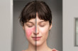 © Alessandro Grandini - rosacea: before and after the cosmetic treatment of skin disorders
