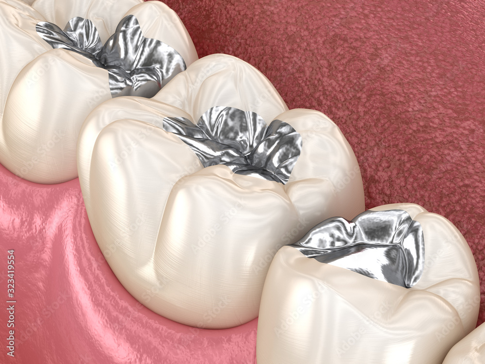 Amalgam restoration. Medically accurate 3D animation of dental concept