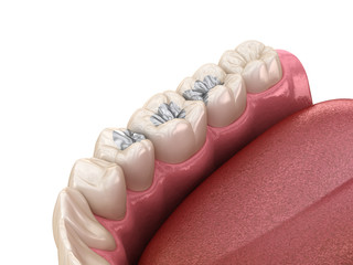 Amalgam restoration. Medically accurate 3D animation of dental concept