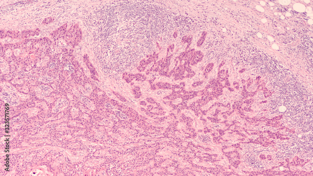 Metastatic squamous cell carcinoma involving a cervical (neck) lymph ...