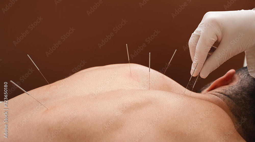 Close-up needle in the back of man during acupuncture procedure on a brown background. Acupuncture. Macro - obrazy, fototapety, plakaty 