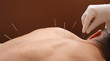 Close-up needle in the back of man during acupuncture procedure on a brown background. Acupuncture. Macro