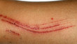 © timonina - Large cut on the leg. Skin abrasion.