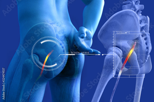 Cuadros en Lienzo Pinched human sciatic nerve, anatomical vision. 3d illustration.