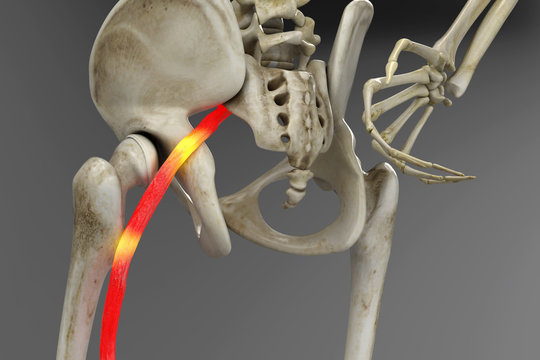 Pinched human sciatic nerve, anatomical vision. 3d illustration.