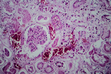 Sticker - Acute glomerulonephritis, light micrograph