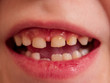 Cute baby shows dropped baby tooth. Child smiles with toothless mouth. Lips and teeth close up