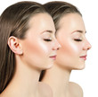 © Galaxy_love_design - Young woman before and after chin correction.