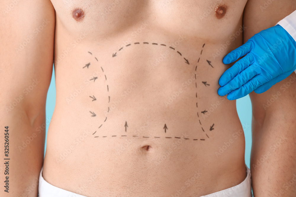 Young man with marks on his body, closeup. Concept of plastic surgery