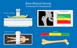 Bone mineral density BMD osteoporosis dual energy X-ray absorptionmetry adult disease equipment medical clinic central DXA pain radiography hospital fragility risk examine