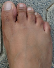 Close Up Of Women's Foot Isolated On A Concrete Floor Background. Foot Is Ugly, Dark Brown And It Has Hair And Veins Showing. No Manicure. Unmanicured Nails.