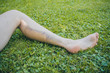 © Anze - Leg of a woman with visible big blue and yellow bruise on calf muscle, due to impact or strong pressure on tissue of a leg. Picture taken outside on a grass