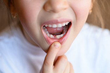 Wall Mural - Cute preschooler showing her milk tooth fell out and her growing permanent tooth in open mouth. Beautiful smiling preschool girl lost baby tooth. Dental hygiene concept