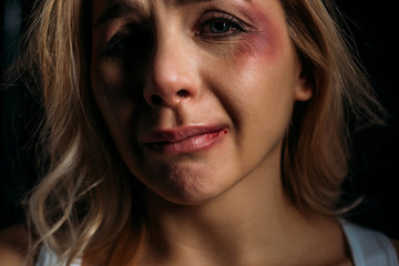 Victim with bruises crying and looking at camera isolated on black