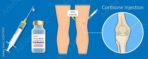 Fotomural Cortisone shots injection epidural steroid ESI lumbar back spinal nerves anti in