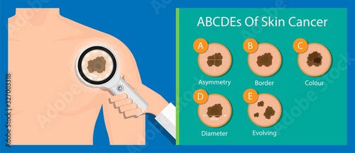 Fotomural Skin cancer treatment diagnosis medical patient screening