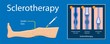 endovenous laser treatment CVD treat ELT legs inject EVLT varicose veins Radiofrequency Ablation RFA	