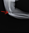 x- ray of the elbow joint with dislocation of the forearm bones