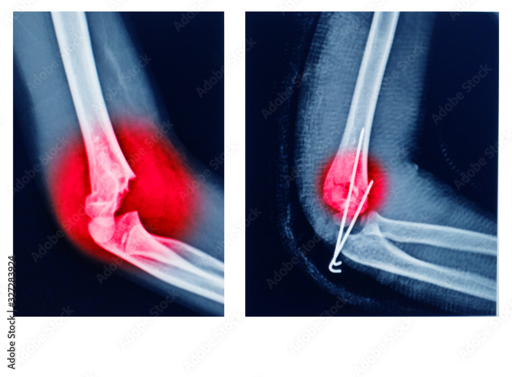 X-ray elbow showing Supracondylar humerus fracture and post opretion ...