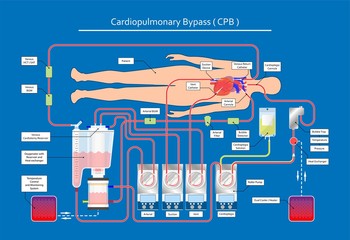 Cardiopulmonary bypass heart lung machine coronary oxygenator perfusiologist cardiologist operating life support artery graft circulation repair mitral tricuspid pulmonic septal defect aneurysms aid