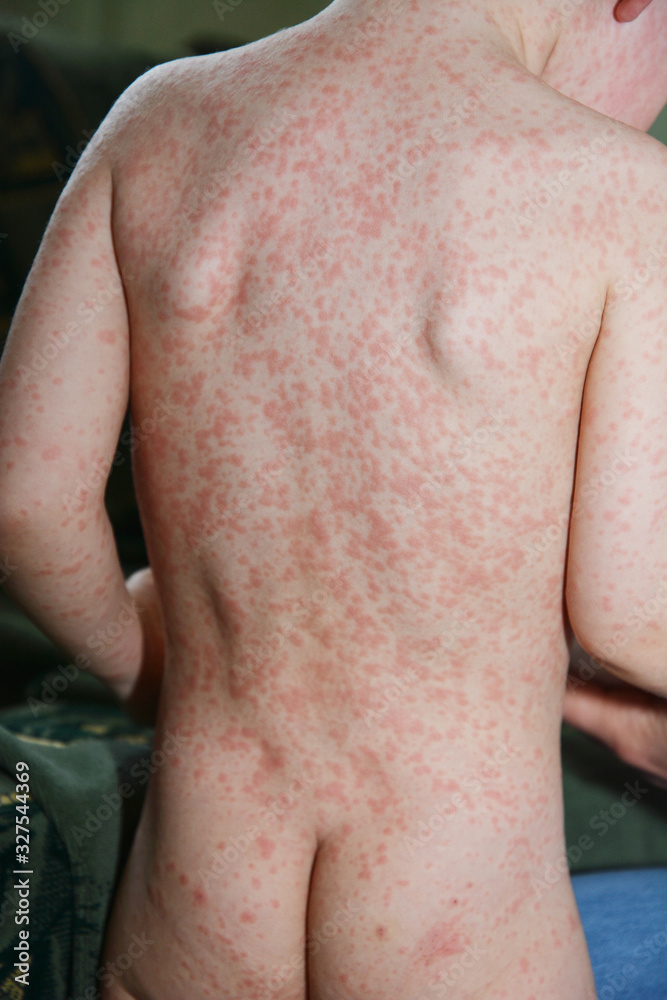 Mono Rash In Children Infectious mononucleosis (IM, mono) child, also known as glandular ...