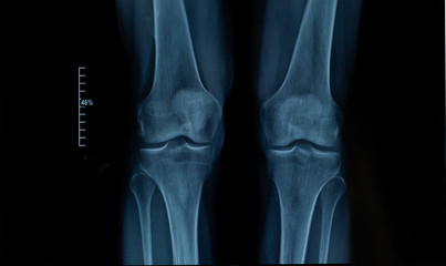 x-ray edk in the knee joint