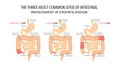 Three most common sites of intestinal involvement in crohn's disease