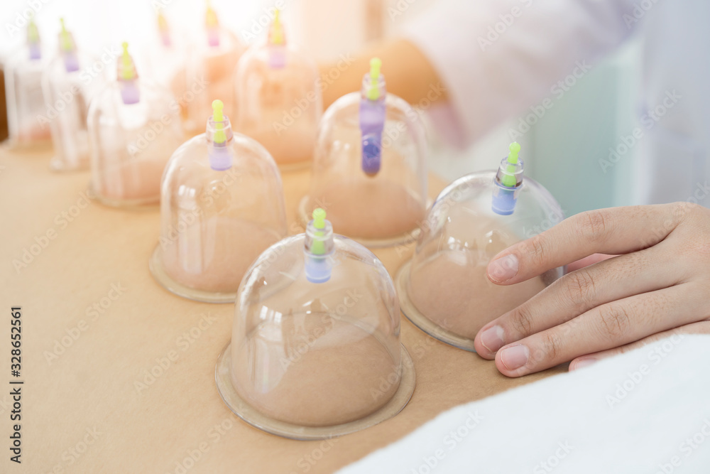young man undergoing acupuncture treatment with Receiving cupping treatment on back or body. Multiple vacuum cup of medical cupping therapy can be good alternative for treatment of back pain, insomnia